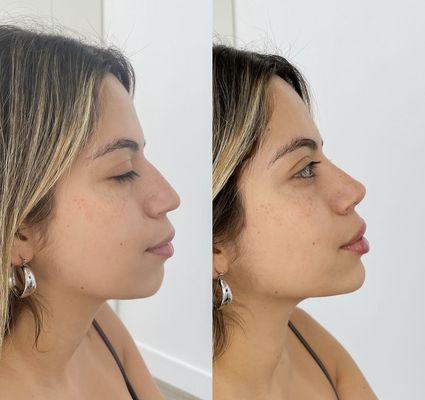 Facial balancing a few drops in right places to achieve beautiful side profile.