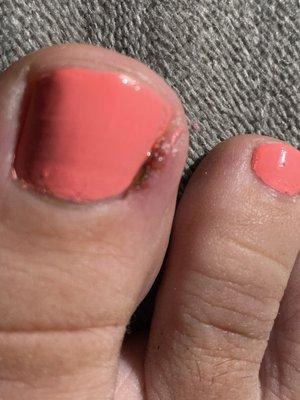 Red, swollen, pus in toe