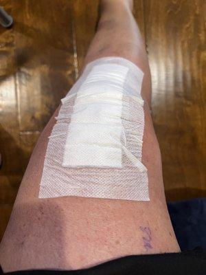 Post operation nano knee procedure