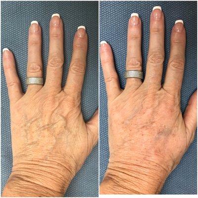 Before (left) and after (right) Radiesse to rejuvenate the hands