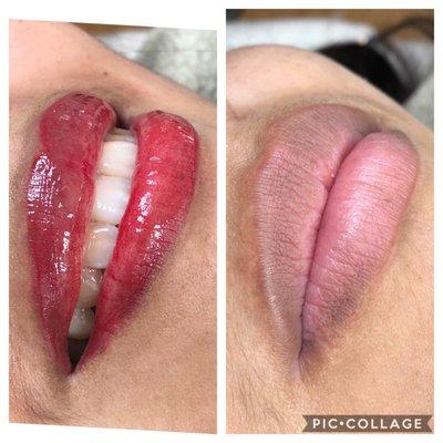 Revitalização labial.