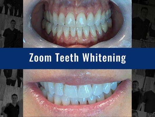 Newbury Dental Group Zoom Teeth Whitening - Thousand Oaks, Camarillo, Moorpark