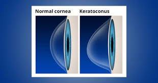 Keratoconus