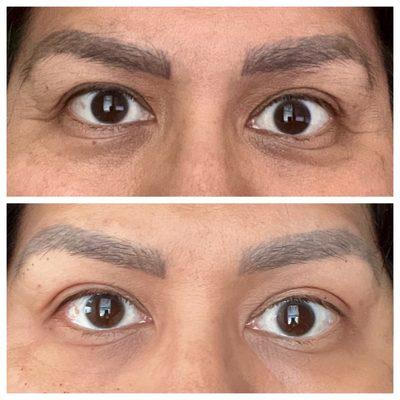 Non surgical eye lift - 7 days post treatment (bottom is after photo)