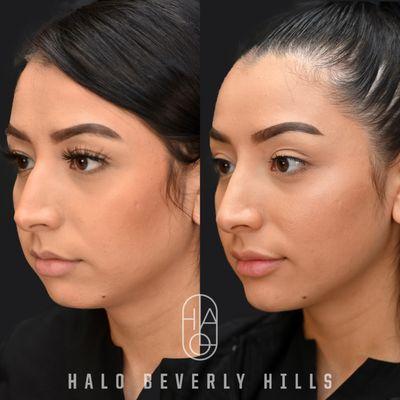 Profile balancing - Nonsurgical Rhinoplasty, Lip augmentation and chin augmentation using filler.