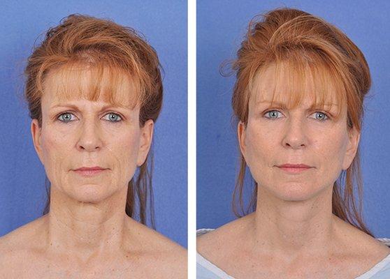 Facelift Before and After l Salt Lake City, UT l Grant A Fairbanks, MD