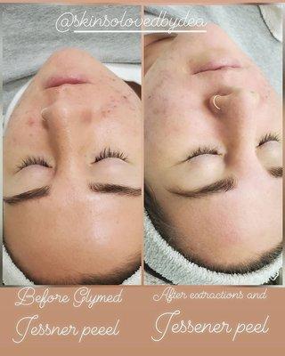 Glymed Jessner Chemical peel