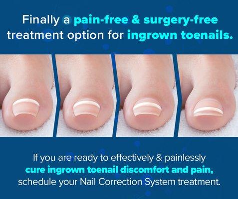 Our Nail Correction System is a completely painless solution to treat ingrown toenails...