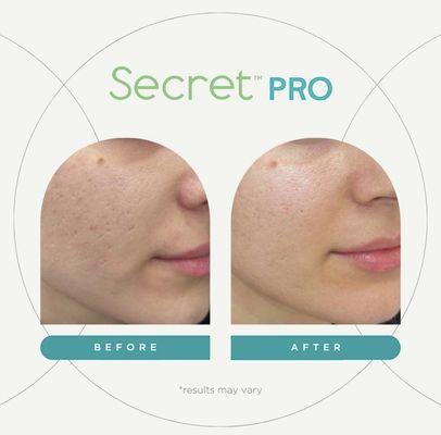 Secret RF - Before & After Acne Scarring