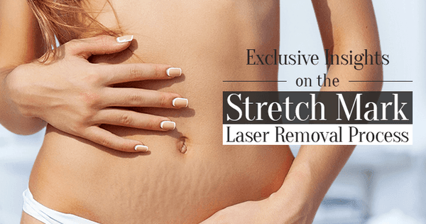 Laser Stretch Marks removal