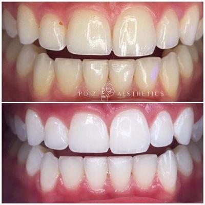 Gleam Cosmetic Teeth Whitening (Session of 80min)