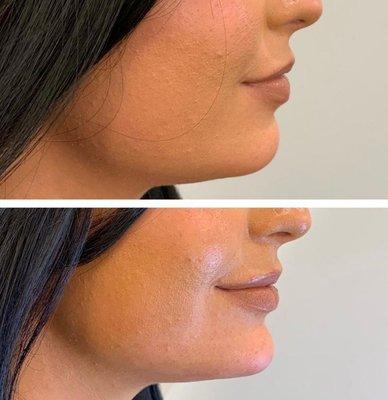 Chin augmentation