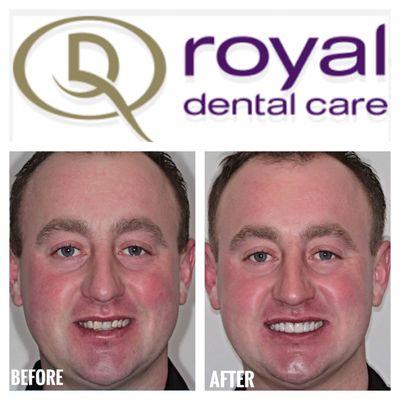 Latest smile transformation done by our talented Dr Evie.