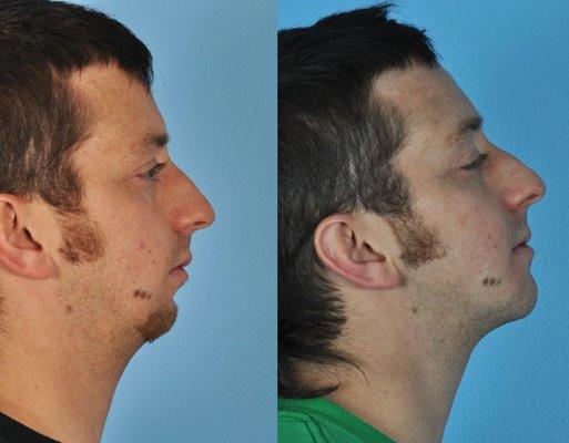 Chin Augmentation