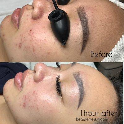 Acne Control Facial