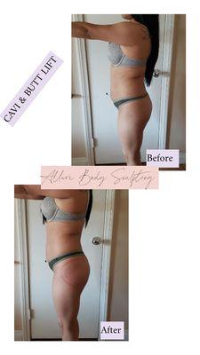 Treatments: Cavitation & Butt Lift
You can see a flatter belly and the a lift butt