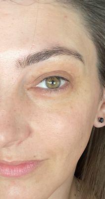 Before under eye PRP treatment