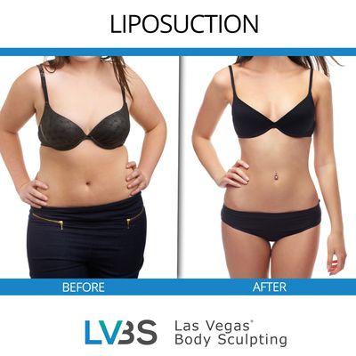 Liposuction - Before & After