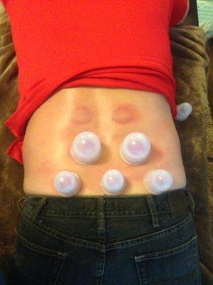 Cupping session on Sciatica