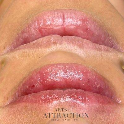 Lip Infusion