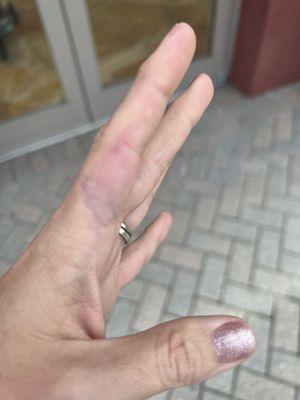 Bruising of my hand that the nail tech did in the manicure