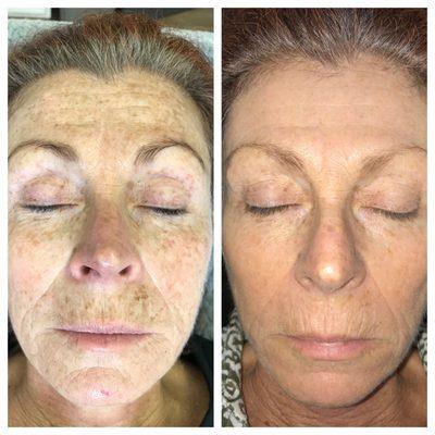 At Tahoe Aesthetics By Candice, I provide skin resurfacing treatments to rejuvenate and refresh your complexion...