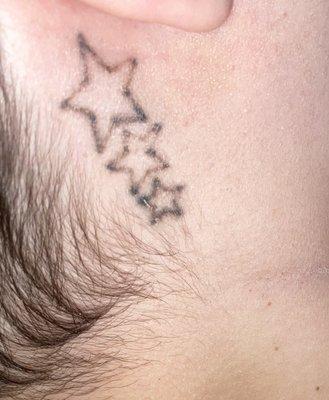 Picture of my tattoo after the first treatment.