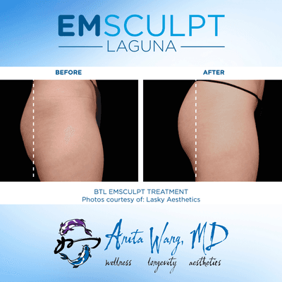 Emsculpt Glutes - lift and pop