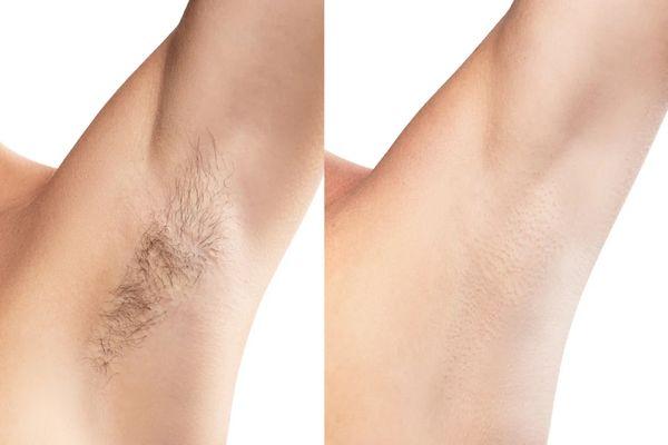 Underarm wax before & after