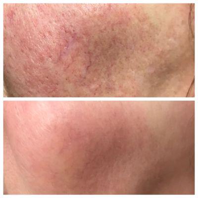 Before and After of Facial veins being treated with VeinGogh