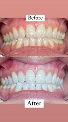 Professional Teeth Whitening that only takes 60-90 minutes $200