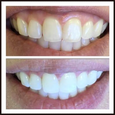 Before and after from our one-hour, in-office Zoom! whitening system.