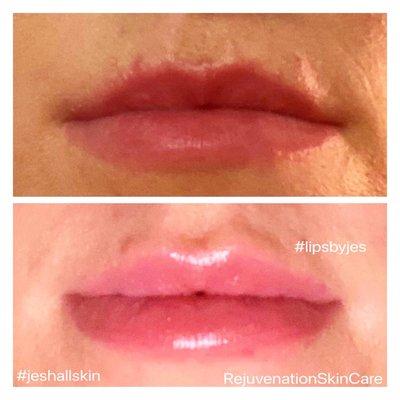 Slight enhancement and asymmetry correction. 0.5 mL of Juvederm Ultra XC was used.