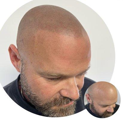 Scalp Micropigmentation