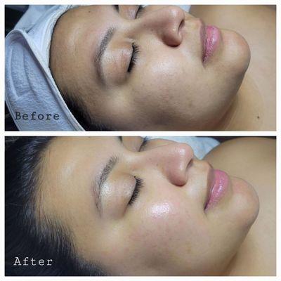 Absolutely Glowing Book a Dermaplane Facial today