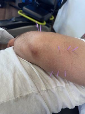 Dry needling to above the knee area.