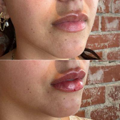 Lip Filler (RHA 2)