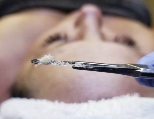 Dermaplaning Facial