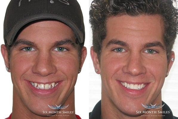 6 month smile before and after