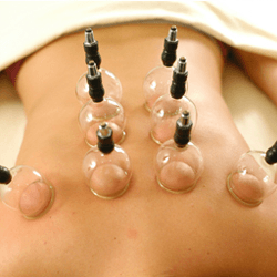 Cupping Therapy