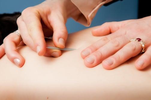 Sustainable Health Acupuncture