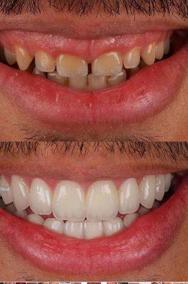 Laser gum lift and porcelain veneers