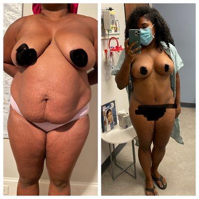 Before and after surgery