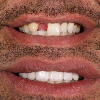 Beautiful Porcelain Veneers