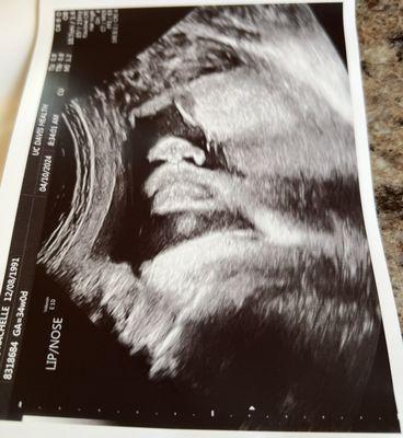 34 week ultrasound, Mirarose was thriving with an average weight & a significant amount of hair!