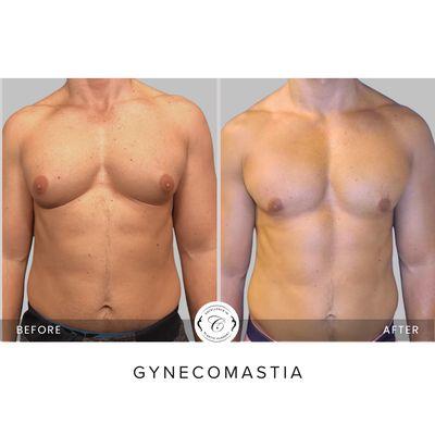 Gynecomastia type 3 before and afters by Top Surgeon, Dr. Joseph Cruise.