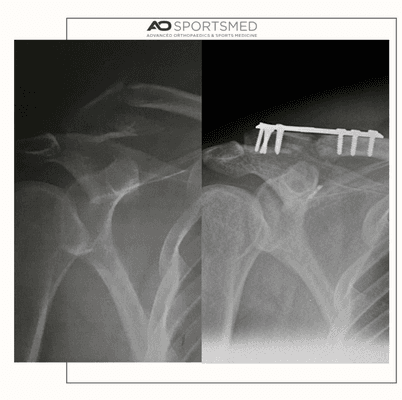 Surgical repair with plating combined with tightrope technology allows for anatomic reduction and full return to function.