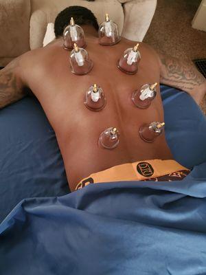 Cupping Therapy