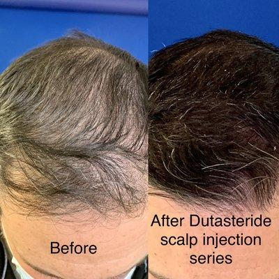 Dutasteride with Minoxidil scalp injections for androgenic hair loss. This is the best treatment available.