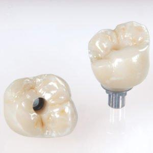 Implant Crowns